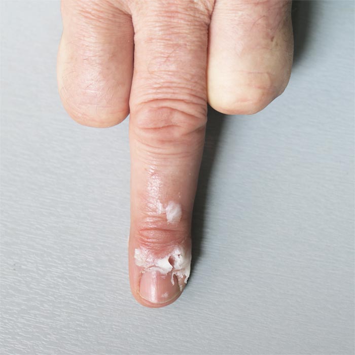 Was ist Smegma, wie schütze ich mich davor, wieviel Hygiene im Intimbereich muss sein und welche Intimpflege ist flasch? Alles über Smegma. Smegma Belag auf Penis und Vorhaut Geruch Intimbereich Mann