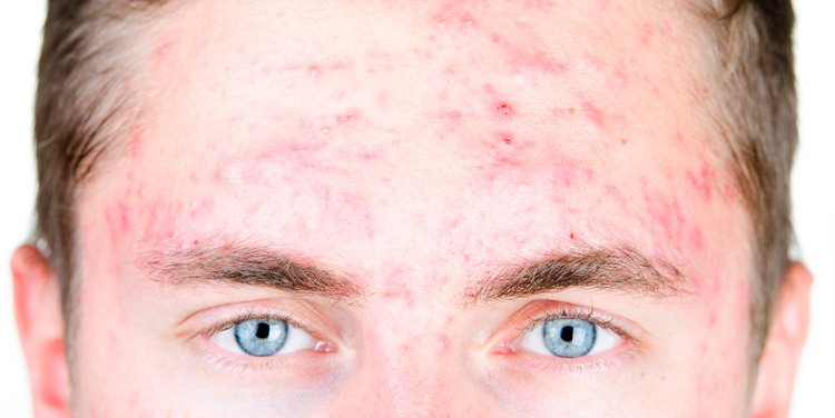 Akne in der Pubertät