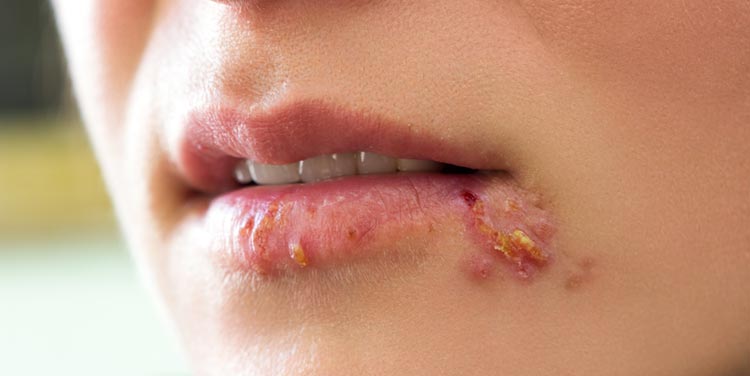 Lippenherpes mit Zitronenmelisse behandeln