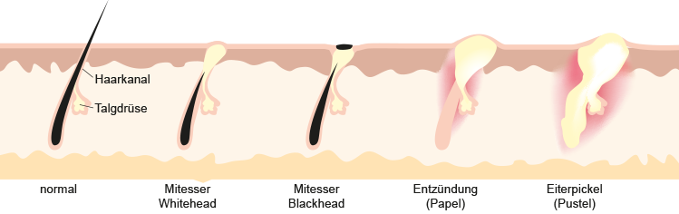 Haut-Unreinheiten Mitesser und Pickel