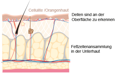 Cellulite Orangenhaut Grafik