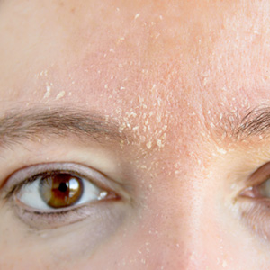 schuppige Haut ist oft ein Anzeichen von empfindlicher Haut